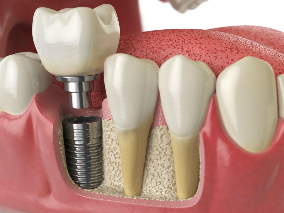 Dental Implants Falls Church, VA