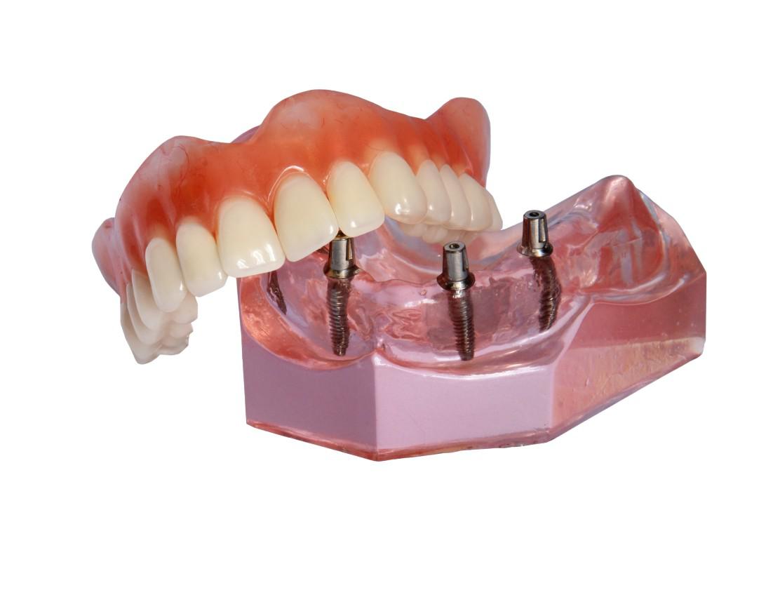 Dental Implants Falls Church, VA